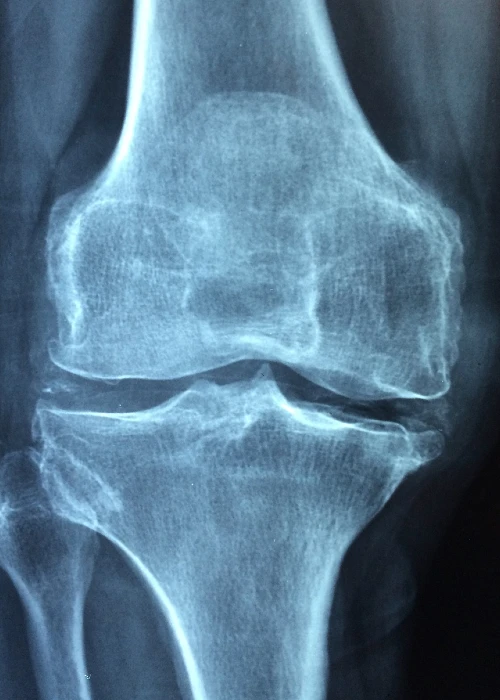 Was hilft am besten bei Arthrose?: Auf einem Röntgenbild ist eine Arthrose sehr gut erkennbar