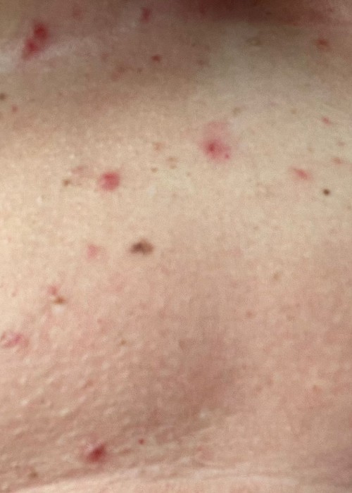 Ganz besonders fies sind Hitzepocken unterhalb der Brüste